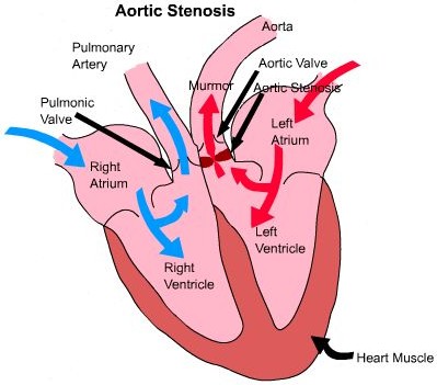 Aortic Stenosis